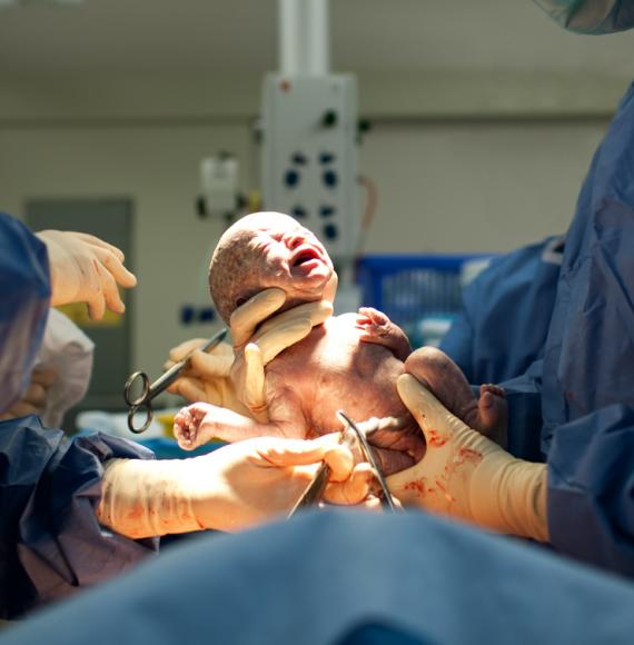 baby being born through ceasarean