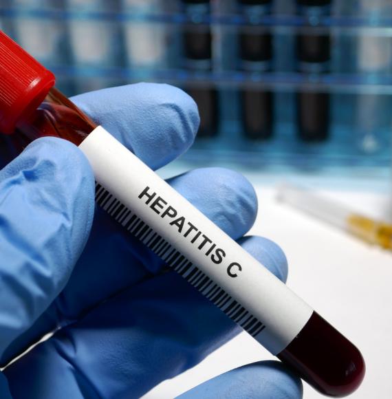 Hepatitis C