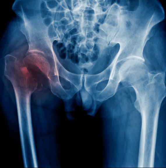 Hip fracture x-ray