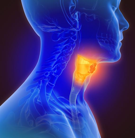 Throat cancer