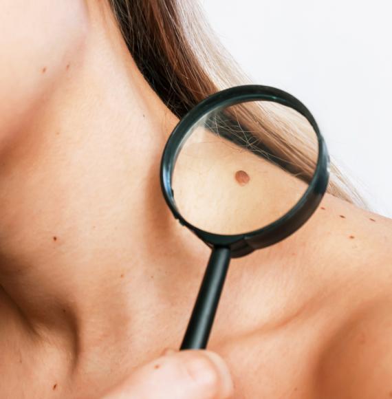 Mole on a woman's neck being magnified