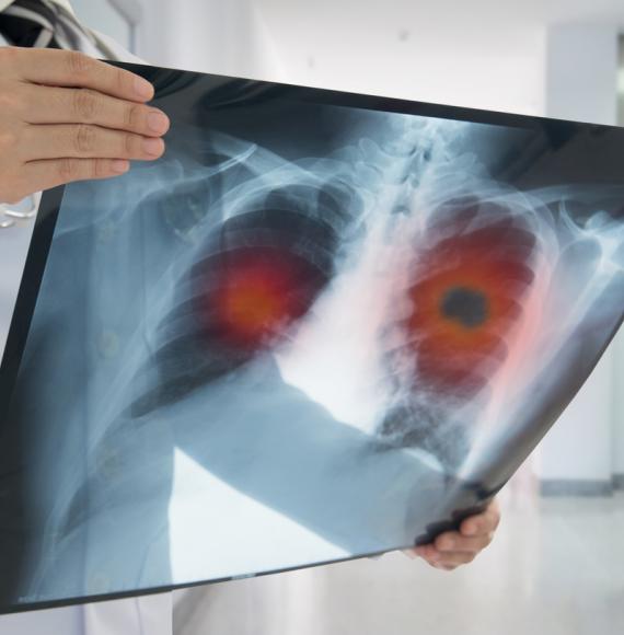 X-ray of lung cancer