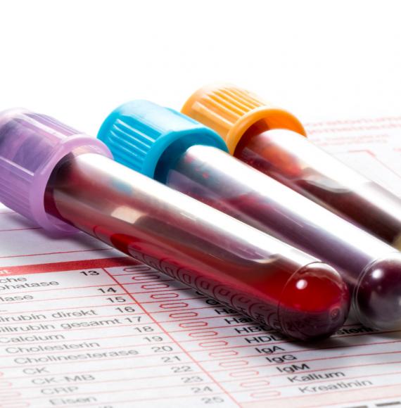 Blood test for Parkinson's disease