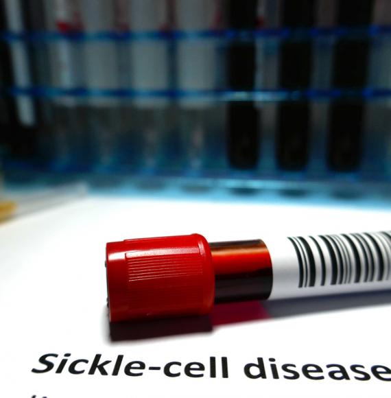 Sickle cell disease