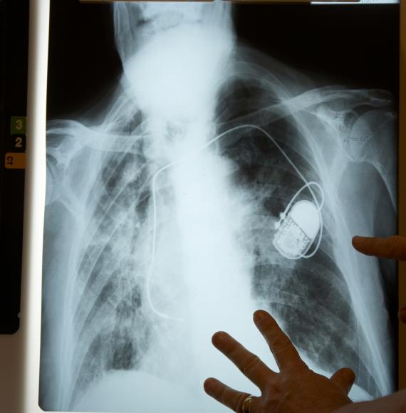 Xray of a pacemaker