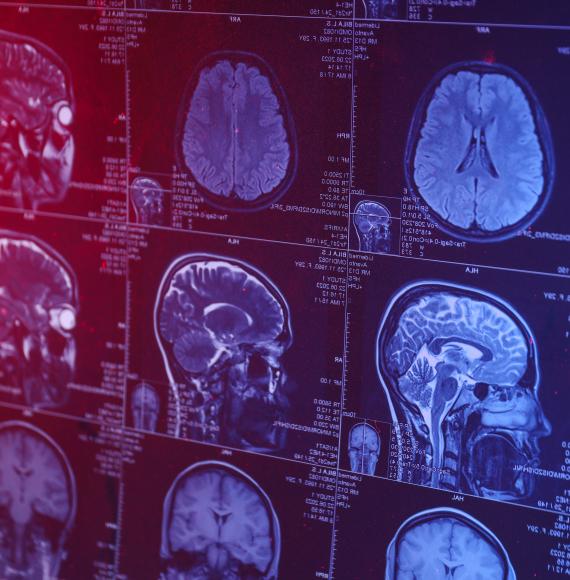 MRI scan of brain