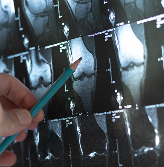 Doctor examining bone tumour