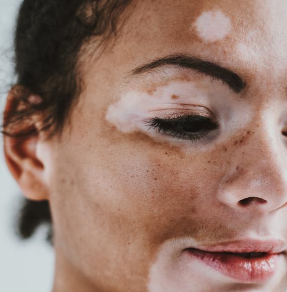 Woman with facial vitiligo