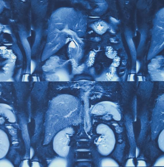 MRI image including bile duct