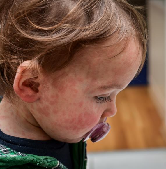 Measles child