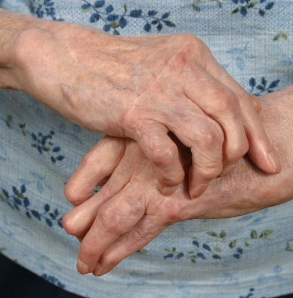 Arthritis