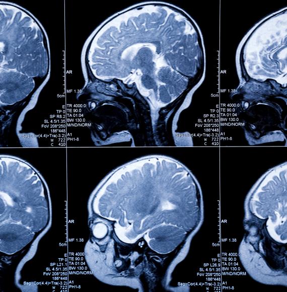 Brain scan