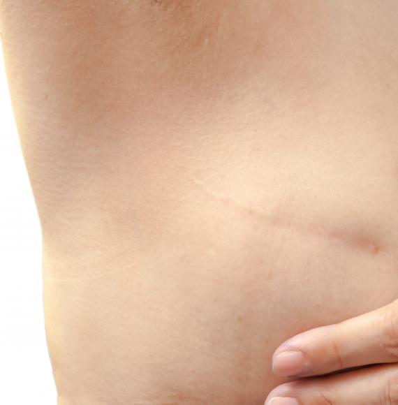 Mastectomy