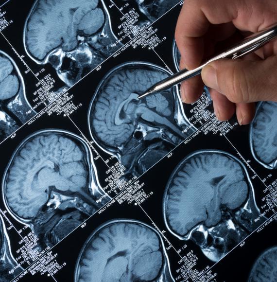 Brain tumour image