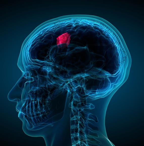 Brain tumour image