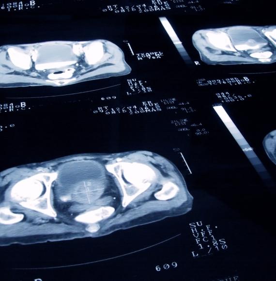 Prostate cancer MRI